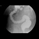 Rectovaginal fistula, diverticular disease of the sigmoid colon: RF - Fluoroscopy